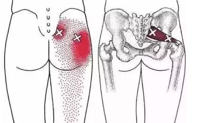 腰臀腿又麻又痛?说不定是患上了梨状肌综合症!