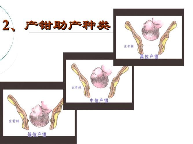产钳的助产术幻灯片教程.ppt
