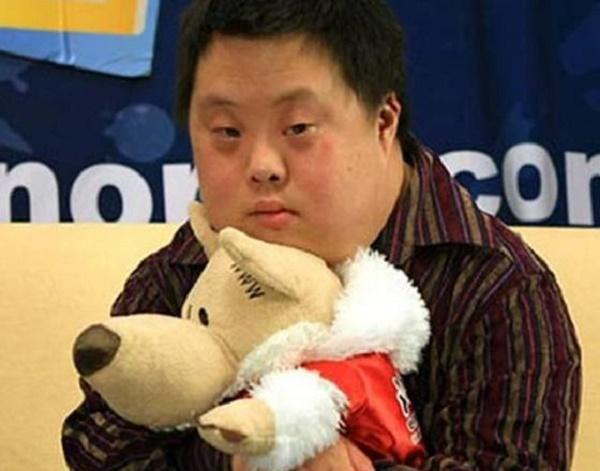 唐氏综合症患儿