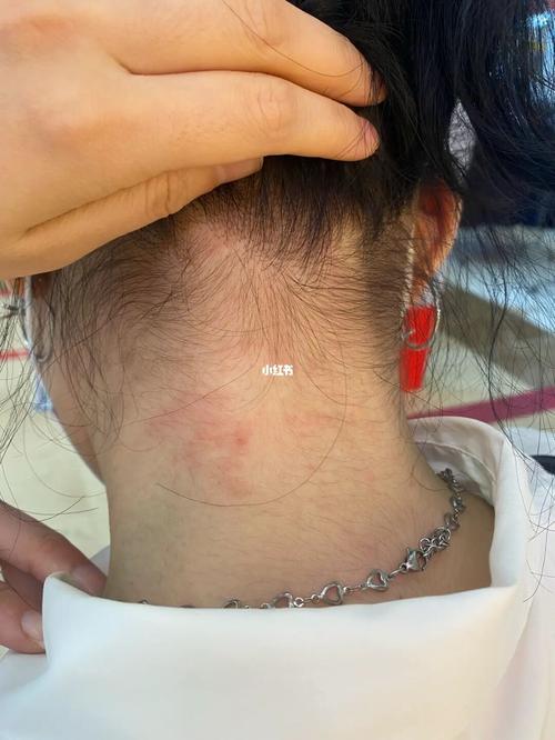 我带bm项链过敏了_过敏_项链_brandy melville自由行热门攻略_brandy