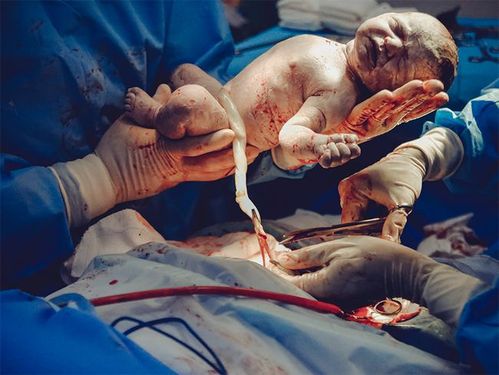 产妇顺产到一半改剖腹产,可胃里满满,如何进行剖腹产的麻醉呢?