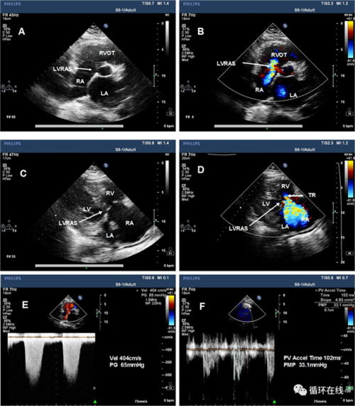 1左室右房分流的超声心动图特征