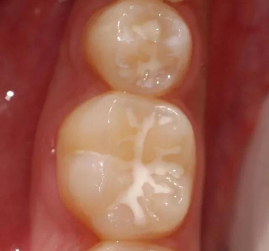 担心宝宝有蛀牙?窝沟封闭了解一下!_牙齿