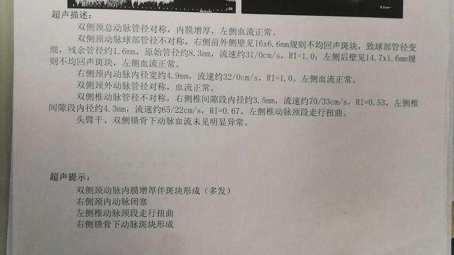 复合手术显神通,颈动脉闭塞疾患除
