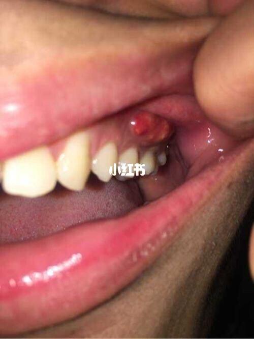 牙龈上长脓包,挤掉后反复长出,怎么回事?_炎症_牙周炎