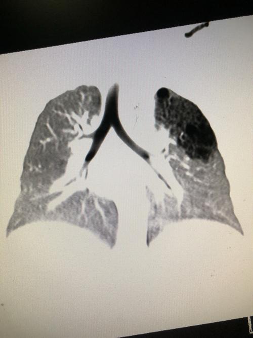 肺囊腺瘤什么东西