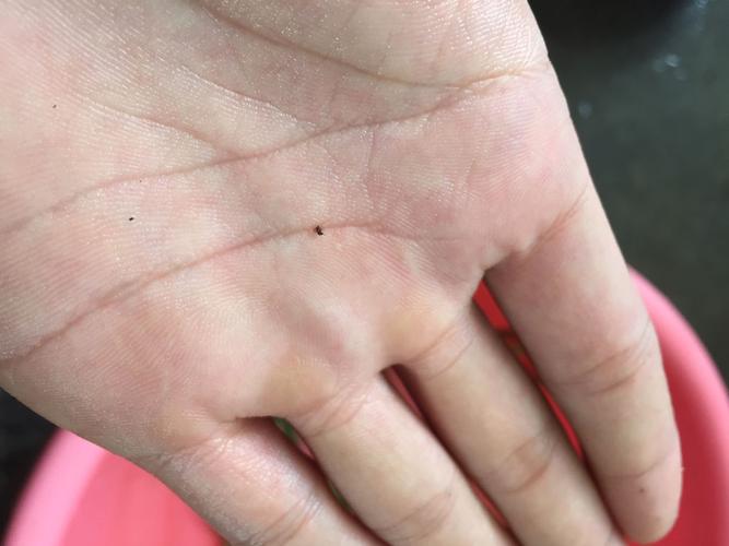 这种叫什么蚊子 咬人非常的痒