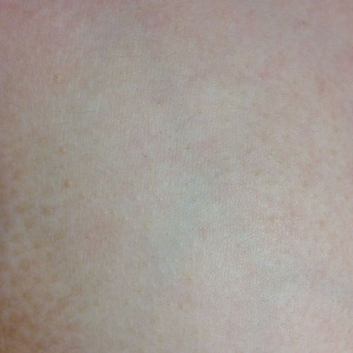 我胸部中间有一块皮肤呈棕色且长毛粗糙请问是什么,怎么样能治好