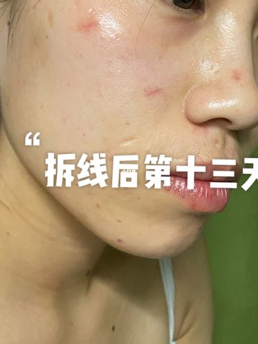 切痣手术拆线后十三天_疤痕_美妆_医美整形