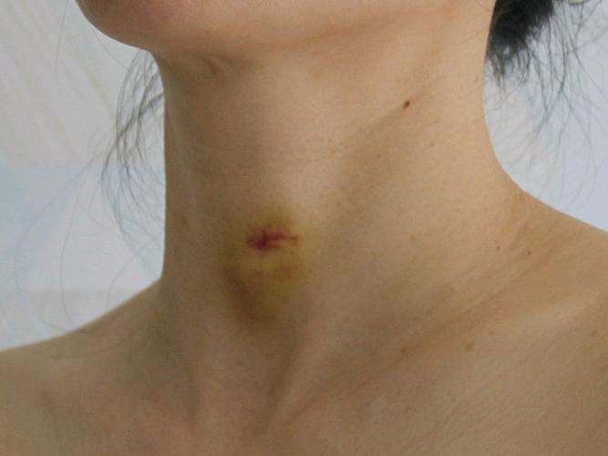 脖子上还有点淤青,希望快快消_圈子-新氧美容整形