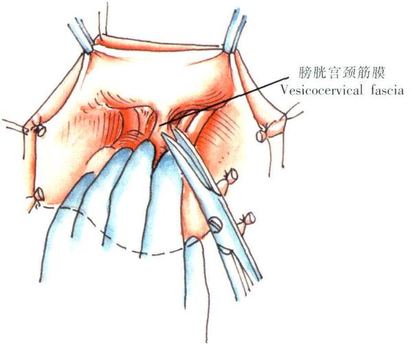 筋膜外扩大全子宫切除术