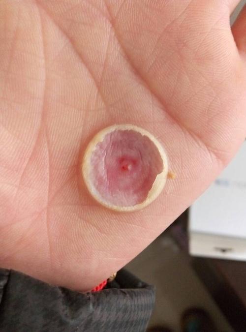 我手上起了鸡眼,然后医生用液氮点鸡眼,起了个紫泡,两