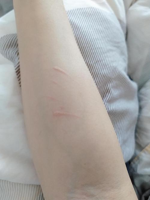 被猫抓破皮要打针吗