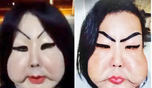 巴西女整容失败脸肿成原先几倍大,众筹失败放弃治疗不