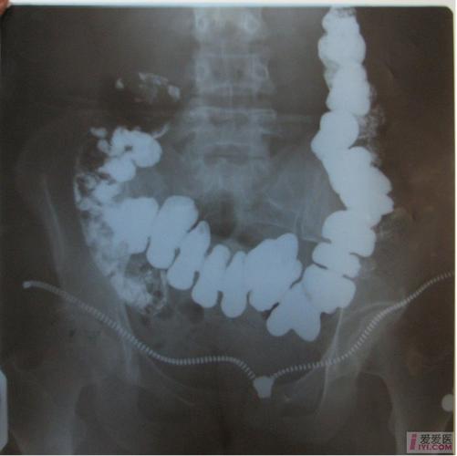 特殊病例---不全肠梗阻?请求支援