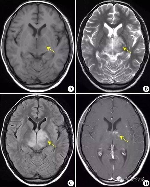 脑白质病变的影像学鉴别诊断