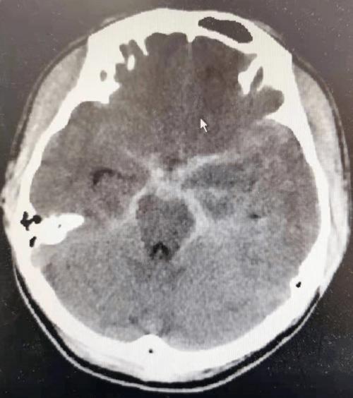 头颅ct示蛛网膜下腔出血