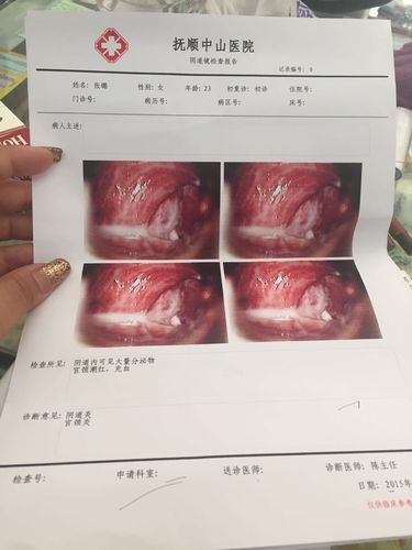 在医院检查出了急性宫颈炎炎不知道严重么