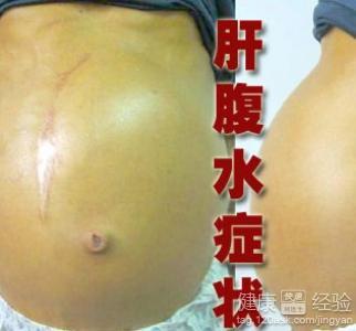 肝腹水肝昏迷还能治好吗