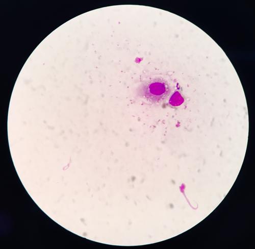 镜下可见巨噬细胞