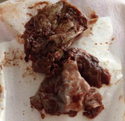 宫颈三度糜烂阴道用药可以治疗吗