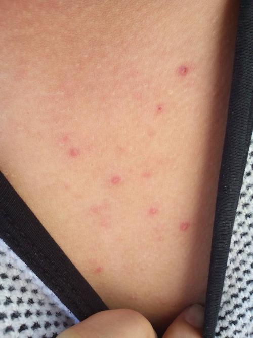 大家帮我看看 我老公身上长这个痘痘是怎么回事?前胸后背长了!