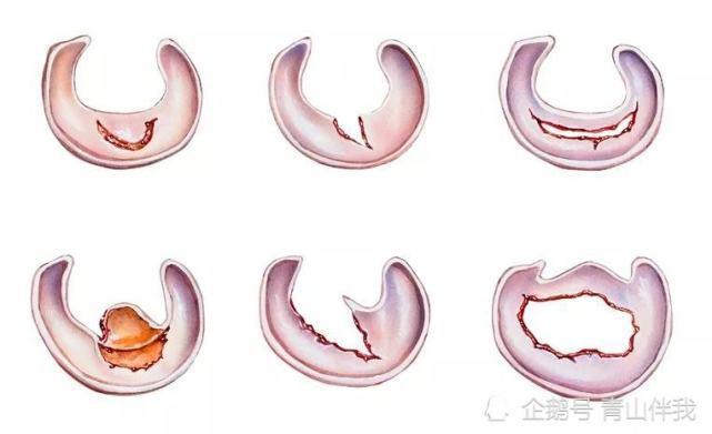 半月板后角损伤的最好治疗方法