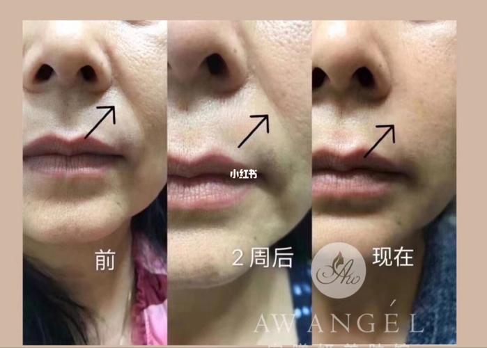 法令纹凹陷 鼻基底凹陷_法令纹_美妆_医美整形