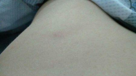 肚皮上半个多月前起了个硬疙瘩,现在按着还略微有点疼是怎么回事