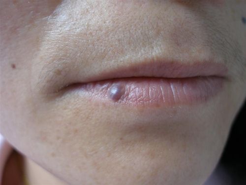 图示病例4 静脉湖