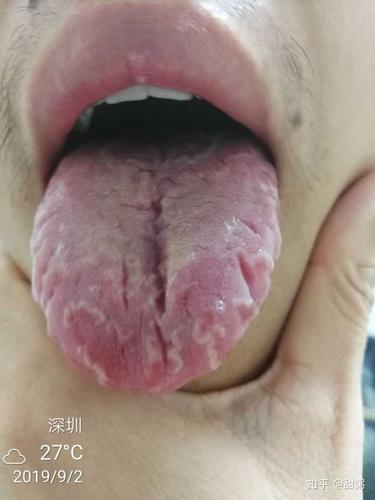 想请教这能估算出是哪种原因导致的裂纹舌吗?