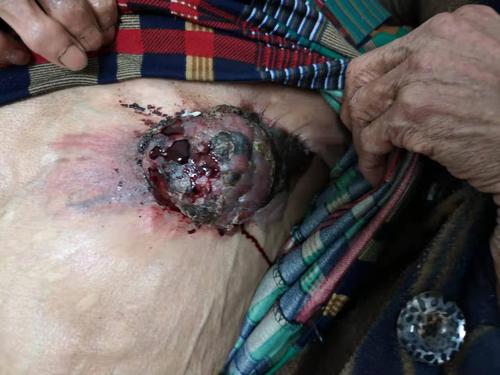 乳腺癌图文简介【一】