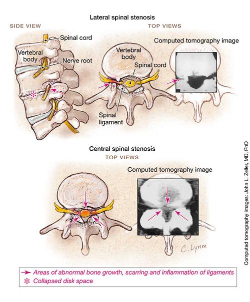spinal stenosis