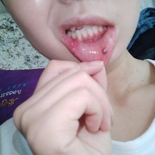 口腔嘴皮内测长了个肉疙瘩,又像水泡,但是实体,长了一