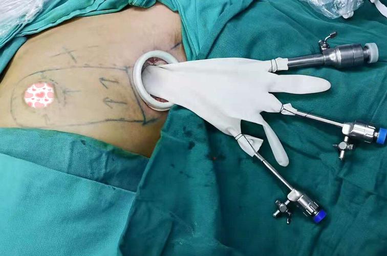 乳腺癌手术方式有哪些,如何选?