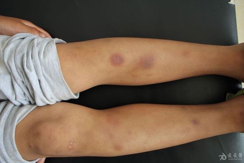 继发性血小板减少紫癜一例. - 皮肤及性传播疾病讨论