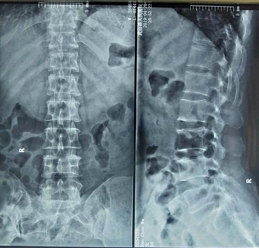 椎间孔镜技术 —— 腰椎间盘突出患者的福音