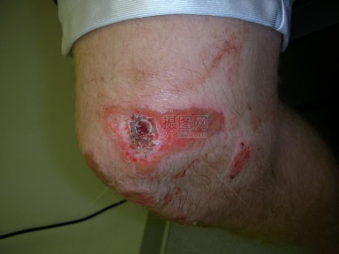 受伤化脓的膝盖