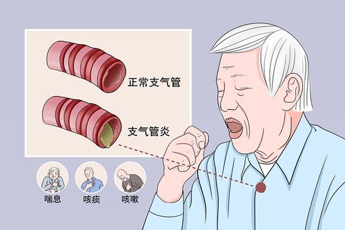 支气管炎
