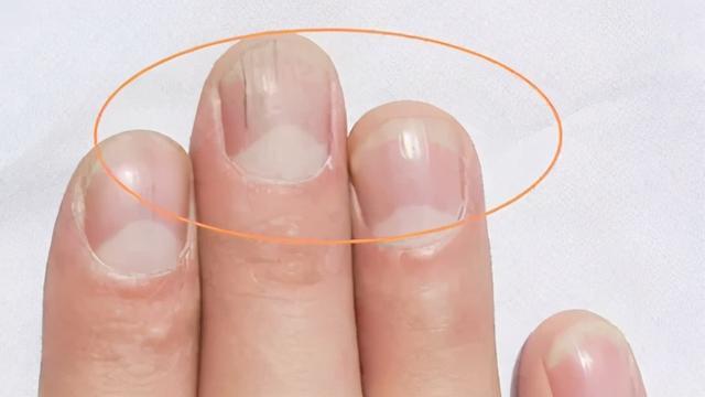 指甲变黄(不吸烟的情况下)是缺乏维生素 e指甲发黄并兼带淡绿色或褐