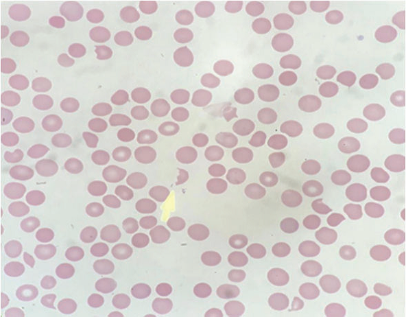 外周血涂片显示大量破裂的细胞和血小板减少(图1).