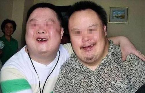 唐氏宝宝有一个很特殊的面容,就是两外眼角上翘,鼻梁扁平,身材矮小