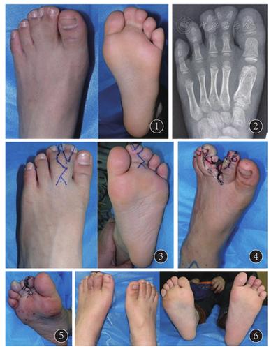 先天性并趾多趾症一例