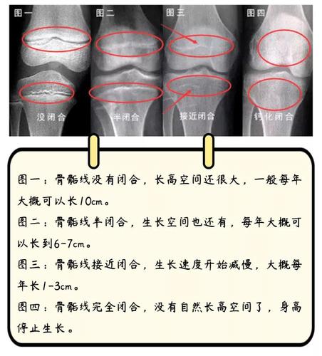 男孩开始长喉结或变声,意味着骨骺线接近闭合了,女孩在月经初潮来后
