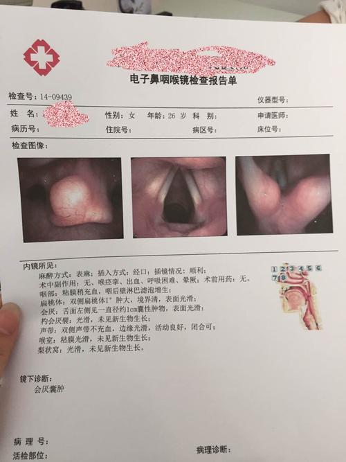 大家帮我看看这个属于什么咽喉炎是单纯性的吗