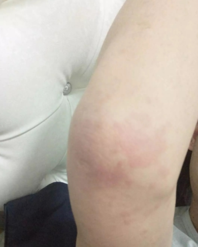 艾滋病初期小红点照片