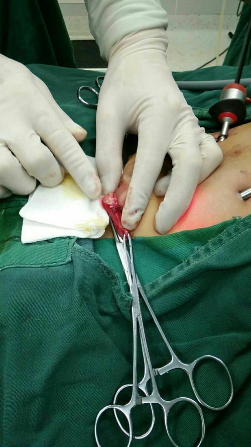 备固定的睾丸.手术历时1小时,患儿麻醉满意,术程顺利,术后安返病区.