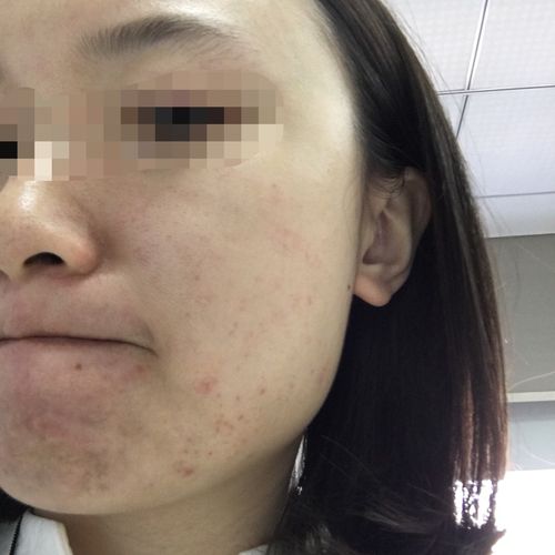 昨晚呕吐以后刷牙,突然发现脸颊有些小红点点,睡觉以后起来更密更红了