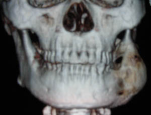 cl0067:下颌骨肿瘤(已手术)