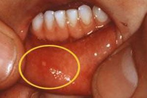 口腔疱疹有什么症状